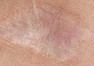 ظهور ضایعات پسوریازیس در محل های آسیب دیده پوست