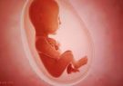 جواز سقط جنین در پسوریازیس شدید مادران باردار