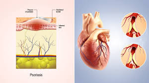 ارتباط بیماری پسوریازیس با افزایش خطر سکته قلبی