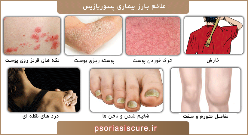 علائم و نشانه های بارز بیماری پوستی پسوریازیس