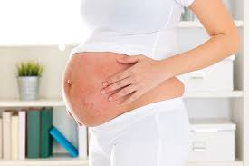 پسوریازیس در دوران لقاح، باروری، بارداری و شیردهی