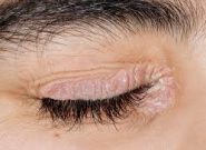 نشانه های پسوریازیس دور چشم و روش های درمان آن