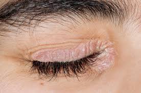 نشانه های پسوریازیس دور چشم و روش های درمان آن