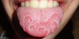 التهابات زبان (زبان جغرافیایی) یکی از تظاهرات بیماری پوستی پسوریازیس