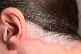 چند راهکار برای درمان پسوریازیس پوست سر