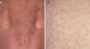پیتریازیس روزه‌آ و پسوریازیس دو بیماری پوستی با باطن متفاوت