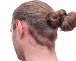 برسی اثرات درمان‌های موضعی برای پسوریازیس پوست سر