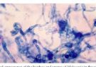 نقش قارچ های مالاسزیا در بیماری پوستی پسوریازیس