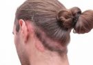 برسی اثرات درمان‌های موضعی برای پسوریازیس پوست سر