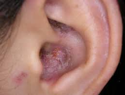 اختلال عملکرد شنوایی در بیماران مبتلا به پسوریازیس و آرتروز پسوریازیس