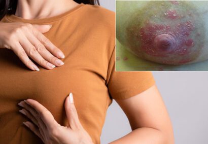 پسوریازیس نوک پستان و آرئول چیست و چگونه کنترل می‌شود؟
